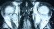 Cavernous hemangioma of the orbit โ CT imaging