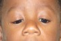 Photograph of a person with congenital ptosis affecting both eyes. The eyes appear partially closed due to the condition.