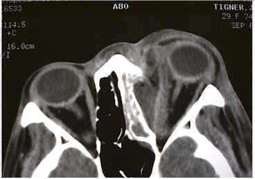 CT of a patient with a subperiosteal abscess