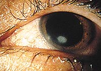 Bacterial Keratitis